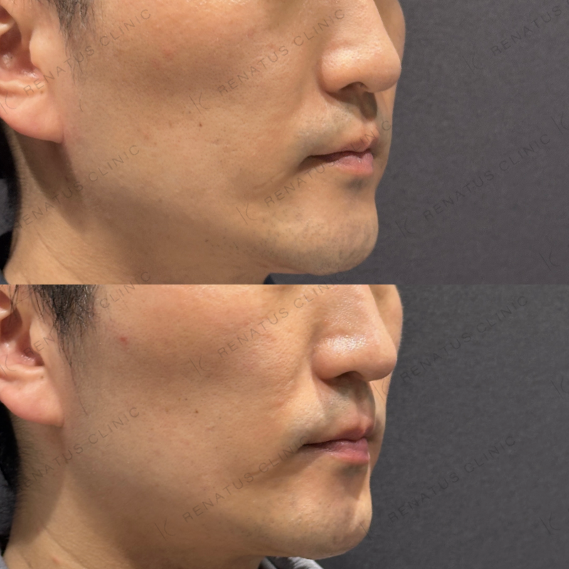 糸リフト症例写真 糸リフト症例写真