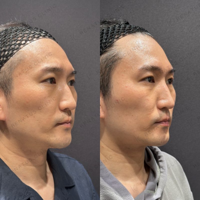 糸リフト症例写真 糸リフト症例写真