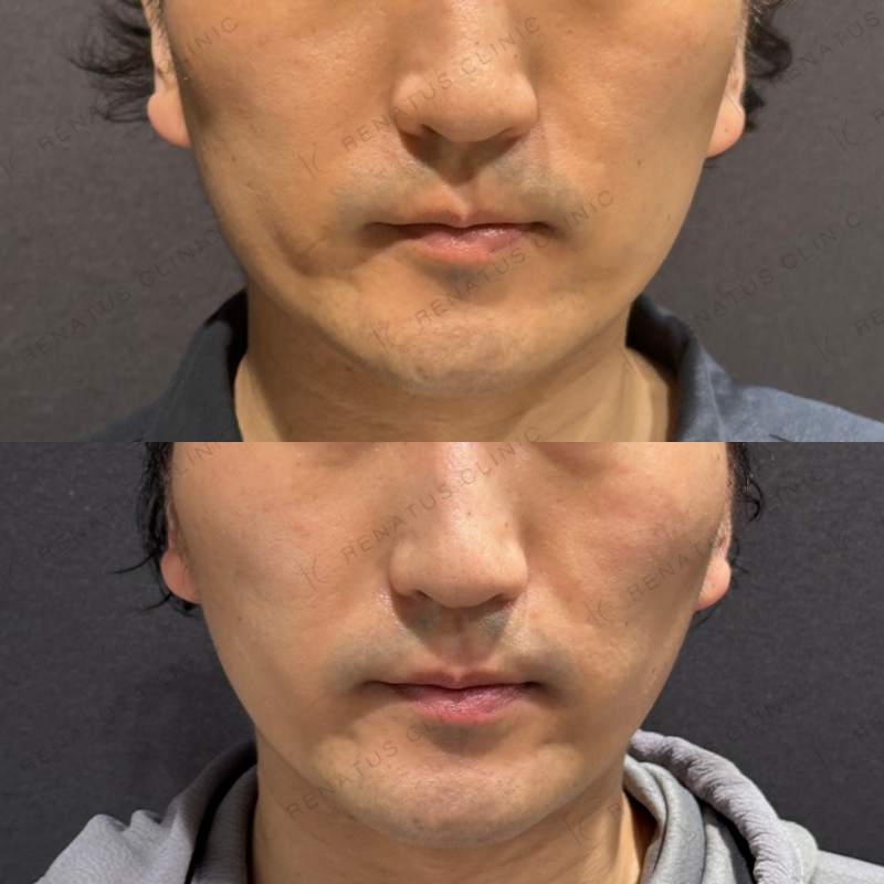 糸リフト症例写真 糸リフト症例写真