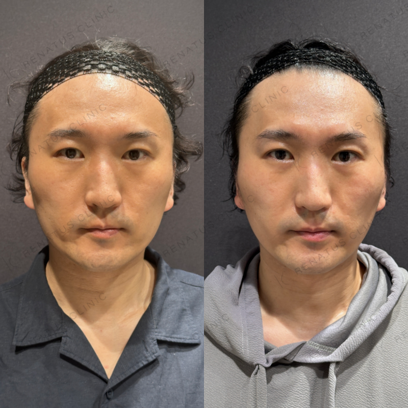 糸リフト症例写真 糸リフト症例写真