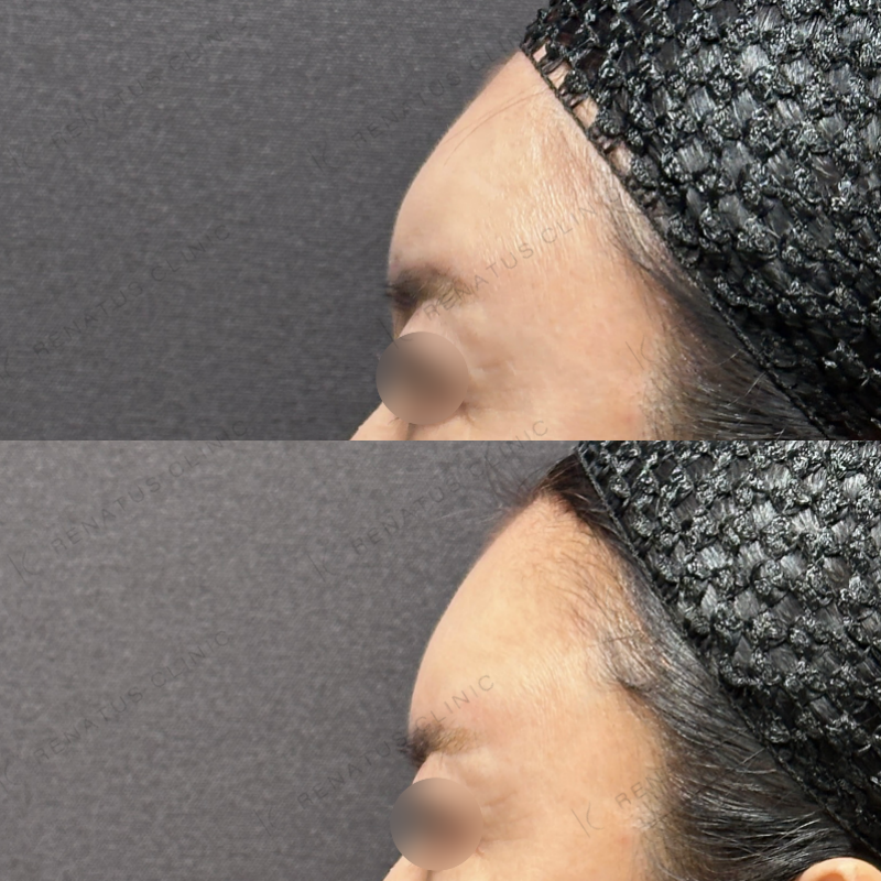 額ヒアルロン酸ボリューマ症例写真 額ヒアルロン酸ボリューマ症例写真