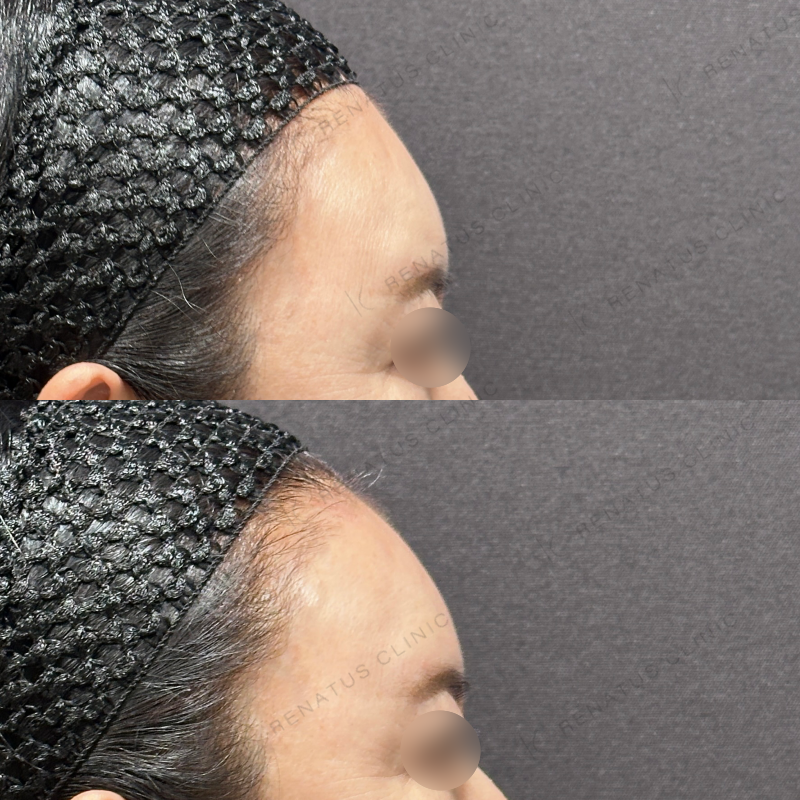 額ヒアルロン酸ボリューマ症例写真 額ヒアルロン酸ボリューマ症例写真