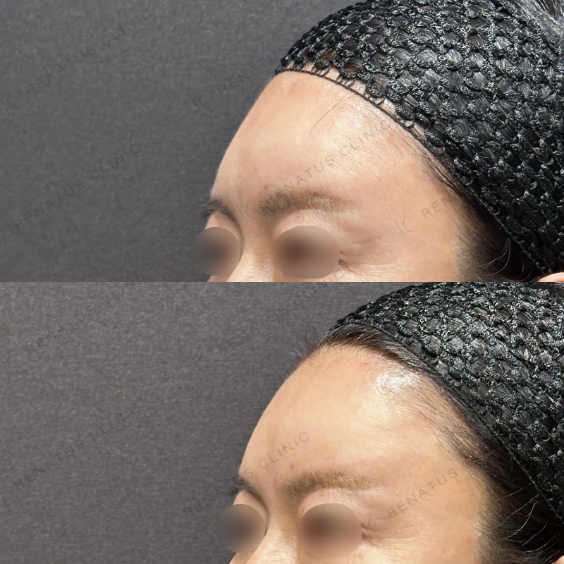 額ヒアルロン酸ボリューマ症例写真 額ヒアルロン酸ボリューマ症例写真