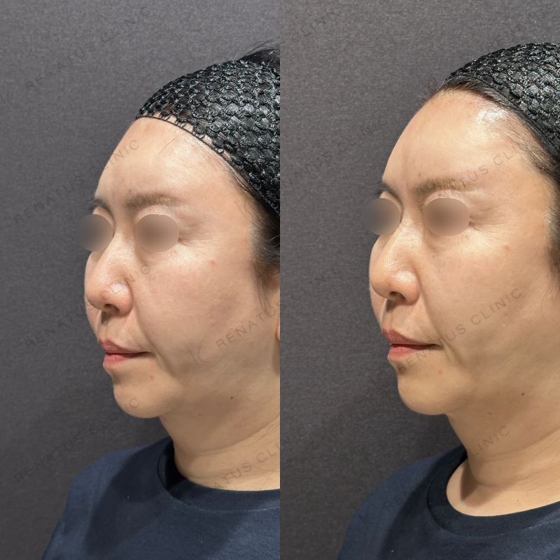 額ヒアルロン酸ボリューマ症例写真 額ヒアルロン酸ボリューマ症例写真