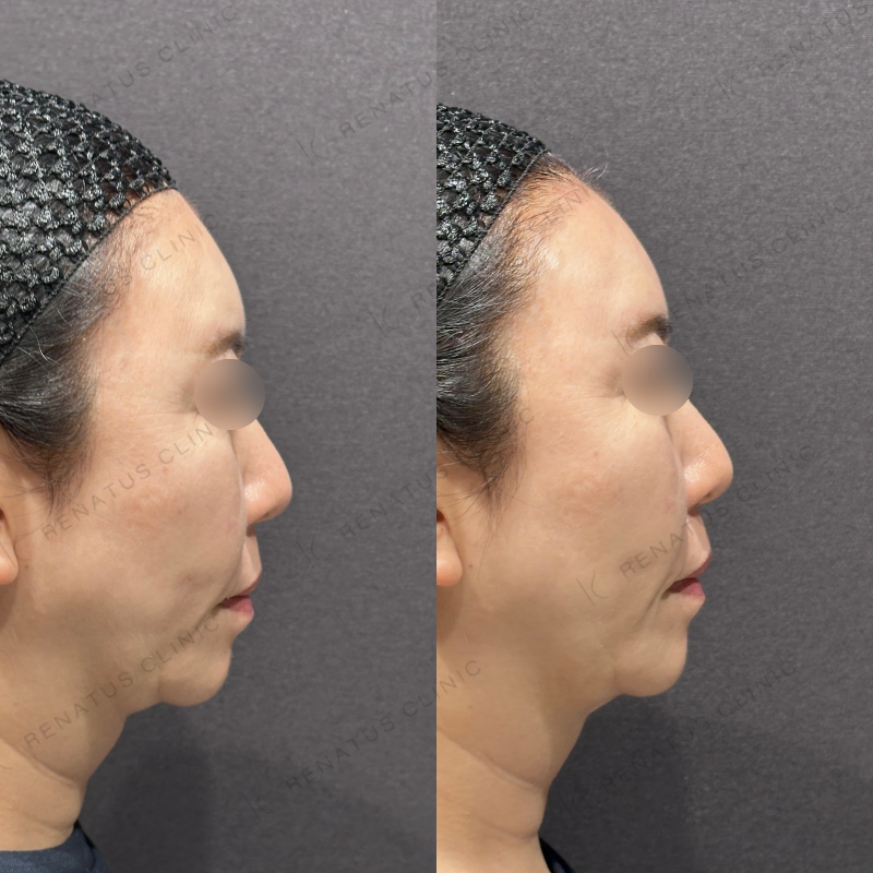 額ヒアルロン酸ボリューマ症例写真 額ヒアルロン酸ボリューマ症例写真