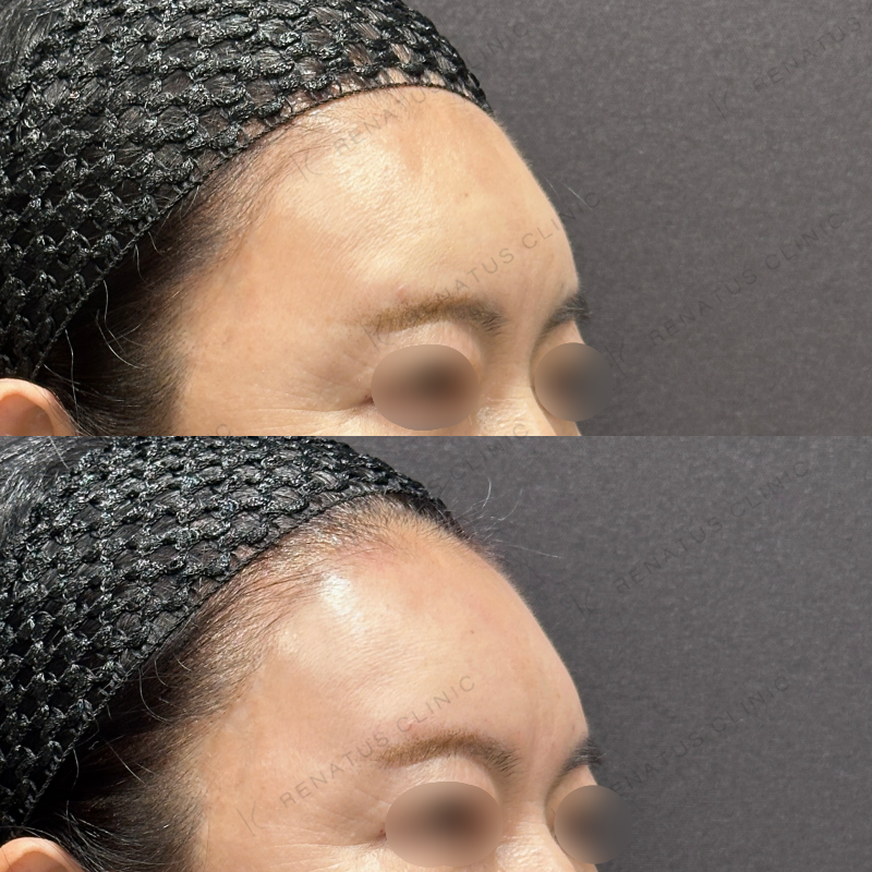 額ヒアルロン酸ボリューマ症例写真 額ヒアルロン酸ボリューマ症例写真