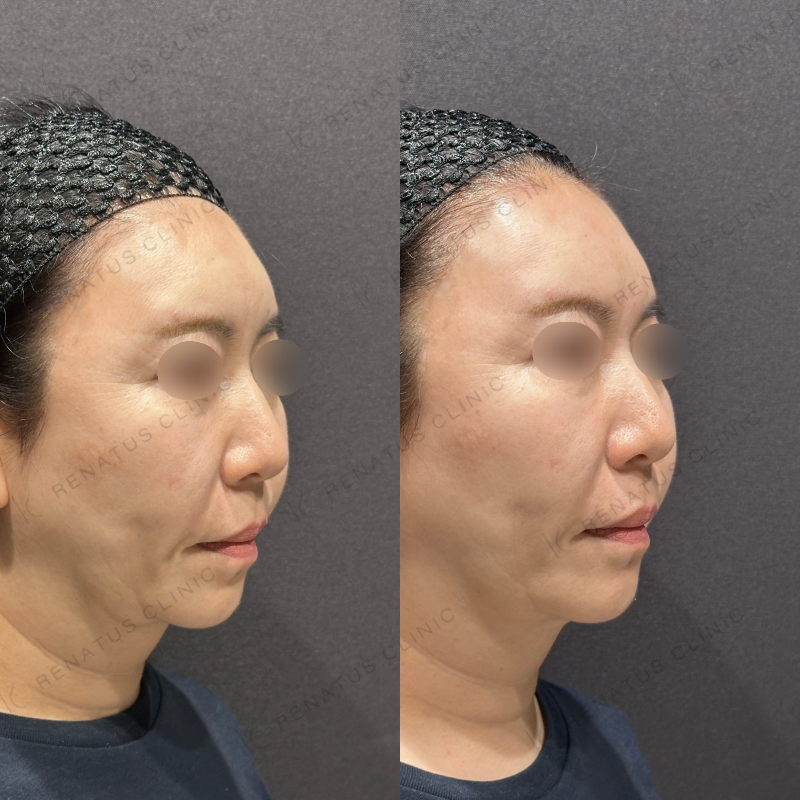 額ヒアルロン酸ボリューマ症例写真 額ヒアルロン酸ボリューマ症例写真