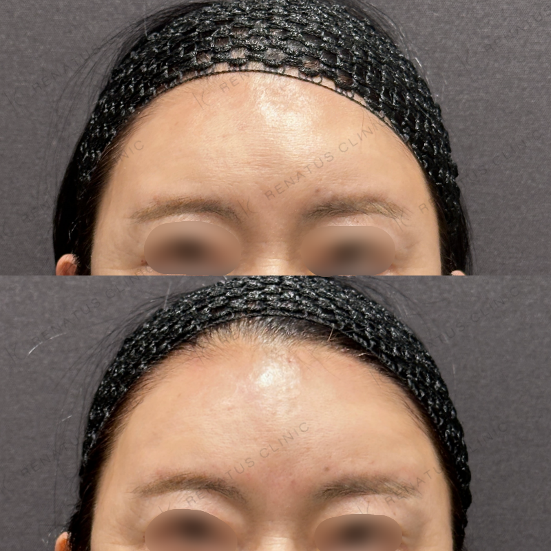 額ヒアルロン酸ボリューマ症例写真 額ヒアルロン酸ボリューマ症例写真