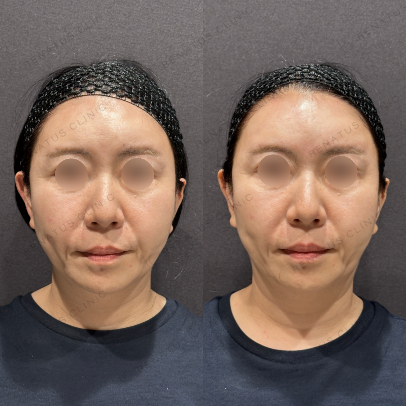 額ヒアルロン酸ボリューマ症例写真 額ヒアルロン酸ボリューマ症例写真