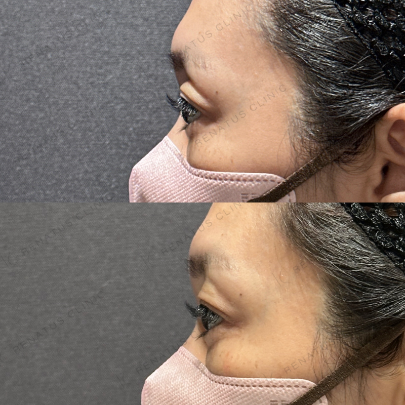 目の上ヒアルロン酸ボルベラ症例写真 目の上ヒアルロン酸ボルベラ症例写真