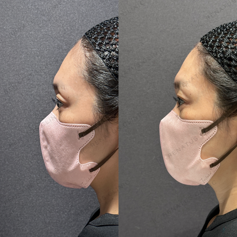 目の上ヒアルロン酸ボルベラ症例写真 目の上ヒアルロン酸ボルベラ症例写真