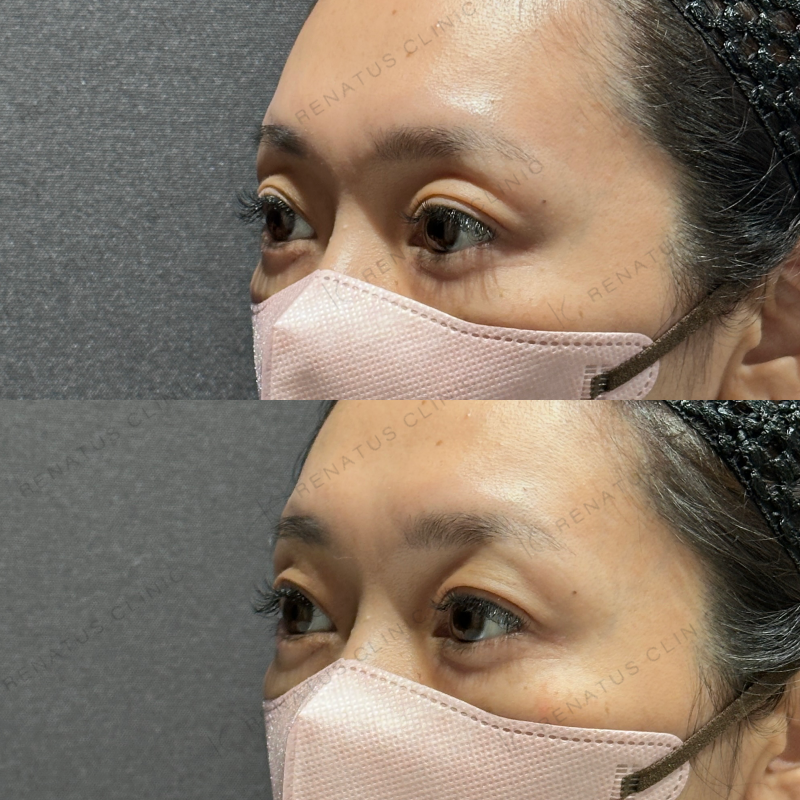 目の上ヒアルロン酸ボルベラ症例写真 目の上ヒアルロン酸ボルベラ症例写真