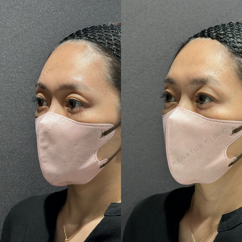 目の上ヒアルロン酸ボルベラ症例写真 目の上ヒアルロン酸ボルベラ症例写真