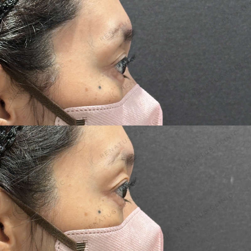 目の上ヒアルロン酸ボルベラ症例写真 目の上ヒアルロン酸ボルベラ症例写真