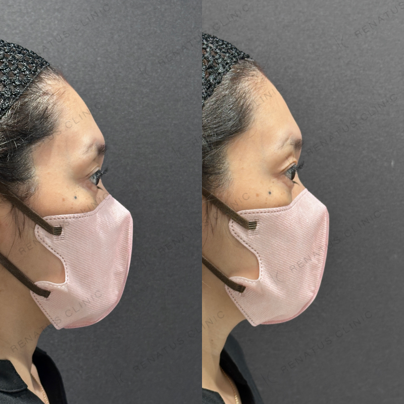 目の上ヒアルロン酸ボルベラ症例写真 目の上ヒアルロン酸ボルベラ症例写真