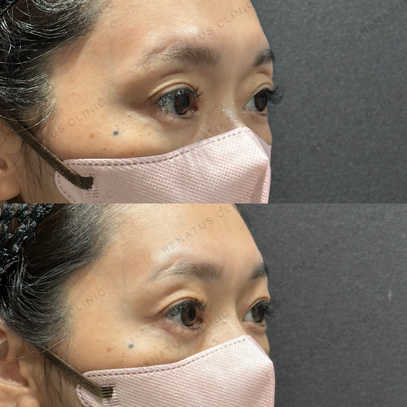 目の上ヒアルロン酸ボルベラ症例写真 目の上ヒアルロン酸ボルベラ症例写真