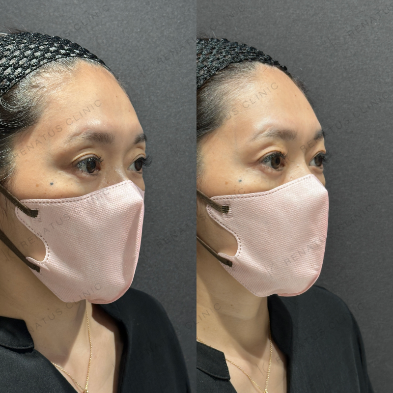 目の上ヒアルロン酸ボルベラ症例写真 目の上ヒアルロン酸ボルベラ症例写真