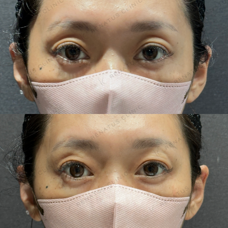 目の上ヒアルロン酸ボルベラ症例写真 目の上ヒアルロン酸ボルベラ症例写真