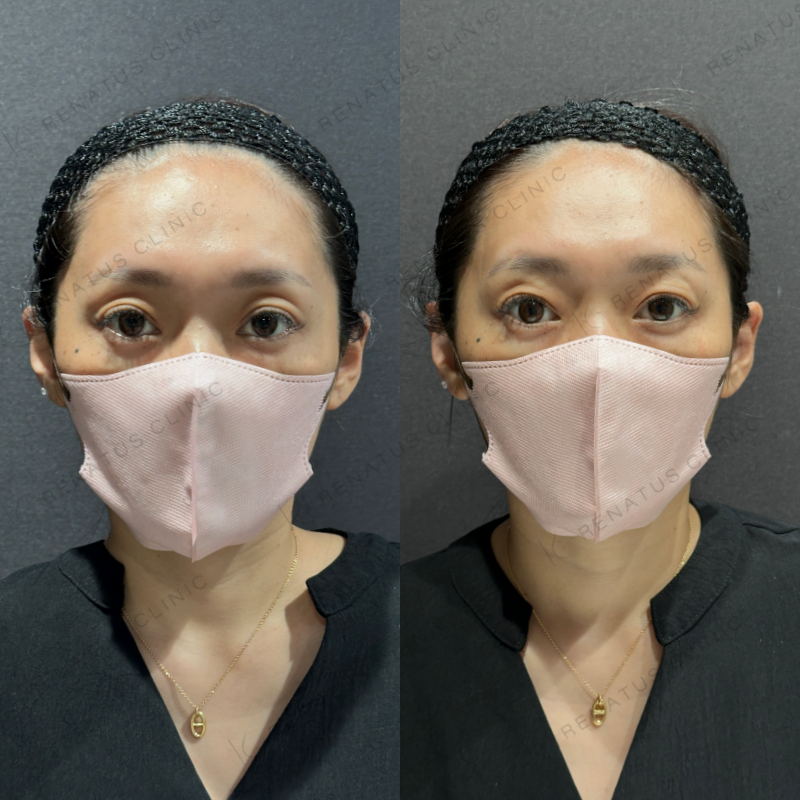 目の上ヒアルロン酸ボルベラ症例写真 目の上ヒアルロン酸ボルベラ症例写真