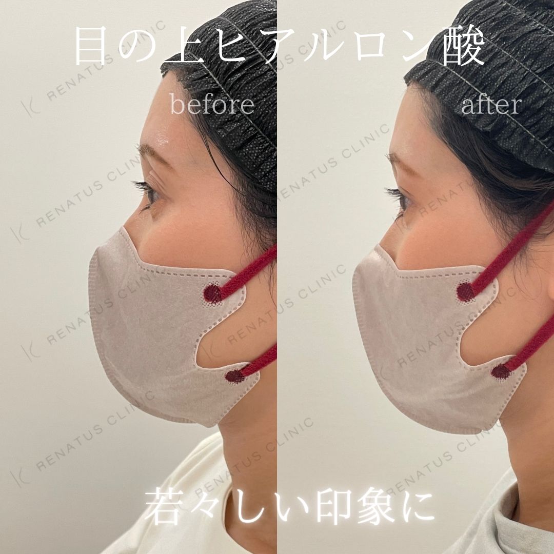 目の上ボルベラヒアルロン酸 目の上ボルベラヒアルロン酸