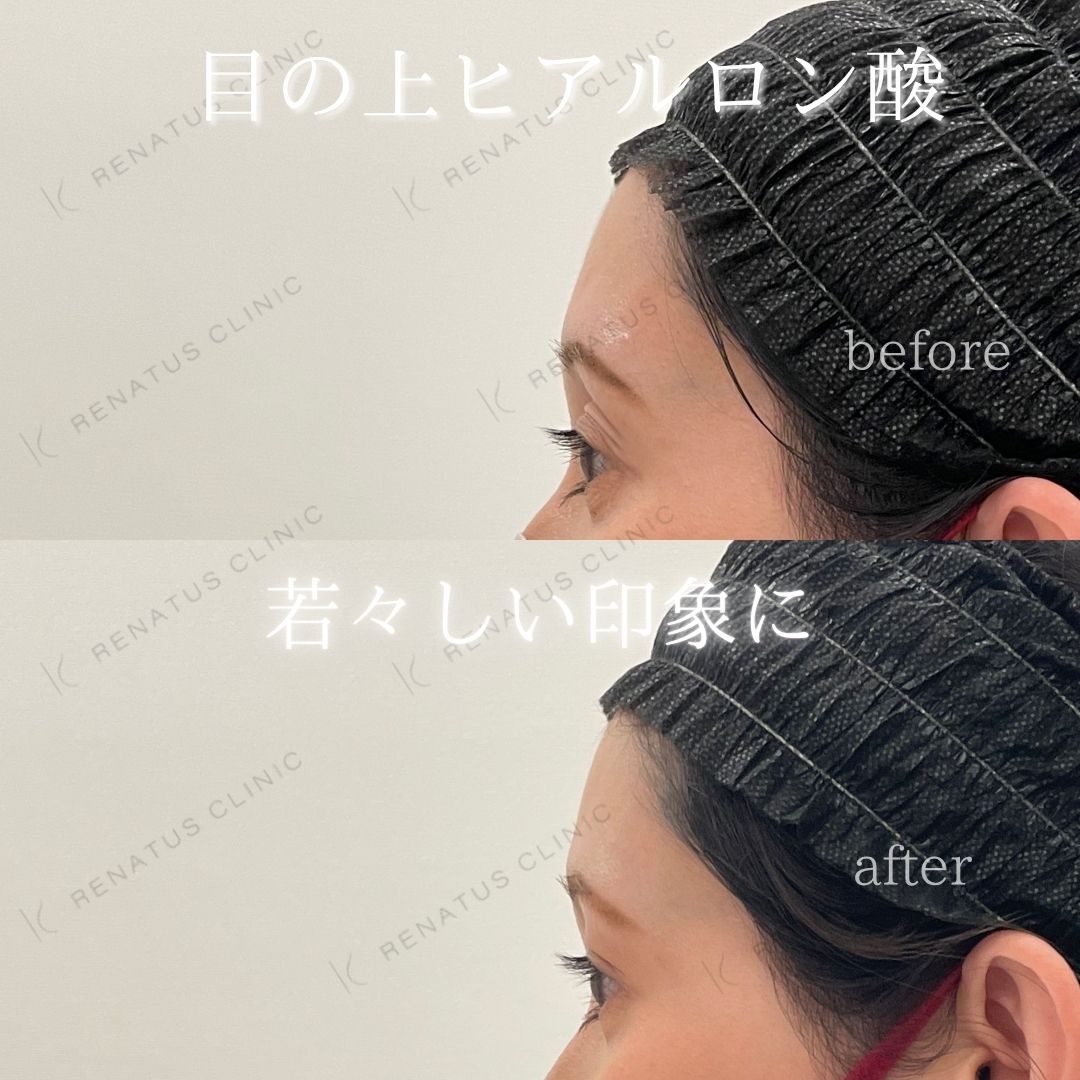 目の上ボルベラヒアルロン酸 目の上ボルベラヒアルロン酸