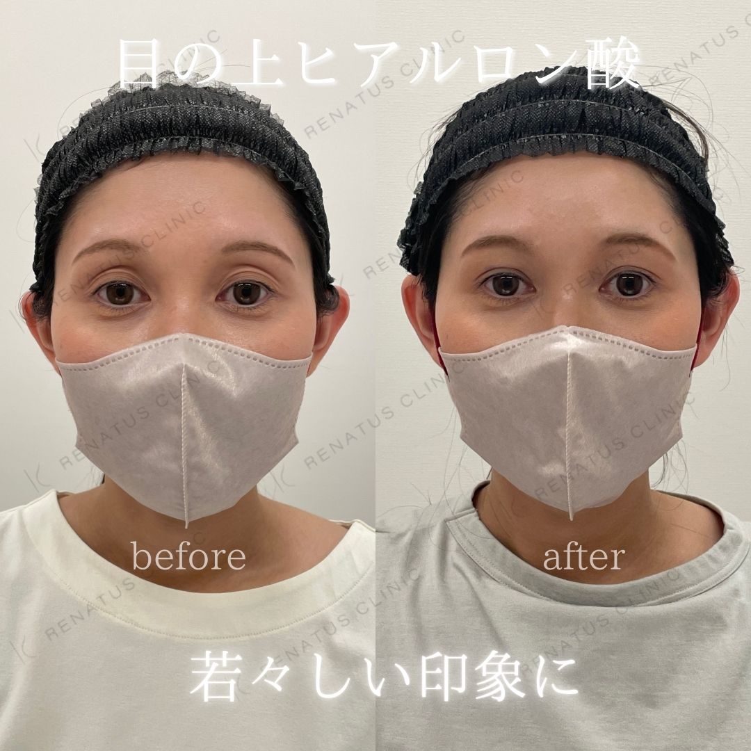 目の上ボルベラヒアルロン酸 目の上ボルベラヒアルロン酸