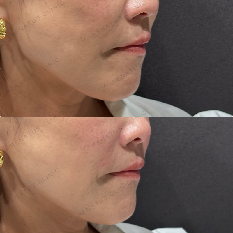 ほうれい線ヒアルロン酸ボリフト症例写真