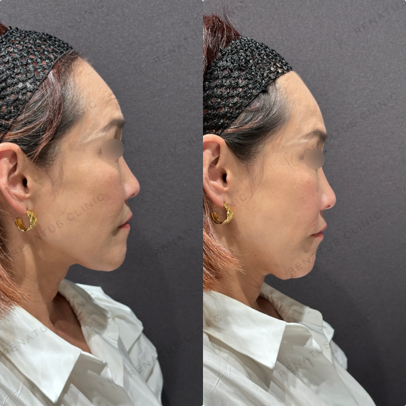 ほうれい線ヒアルロン酸ボリフト症例写真