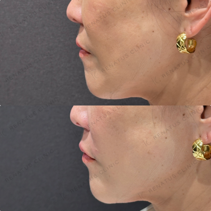 ほうれい線ヒアルロン酸ボリフト症例写真