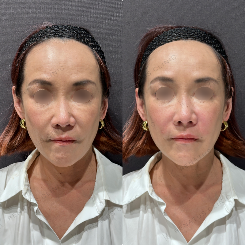 ほうれい線ヒアルロン酸ボリフト症例写真