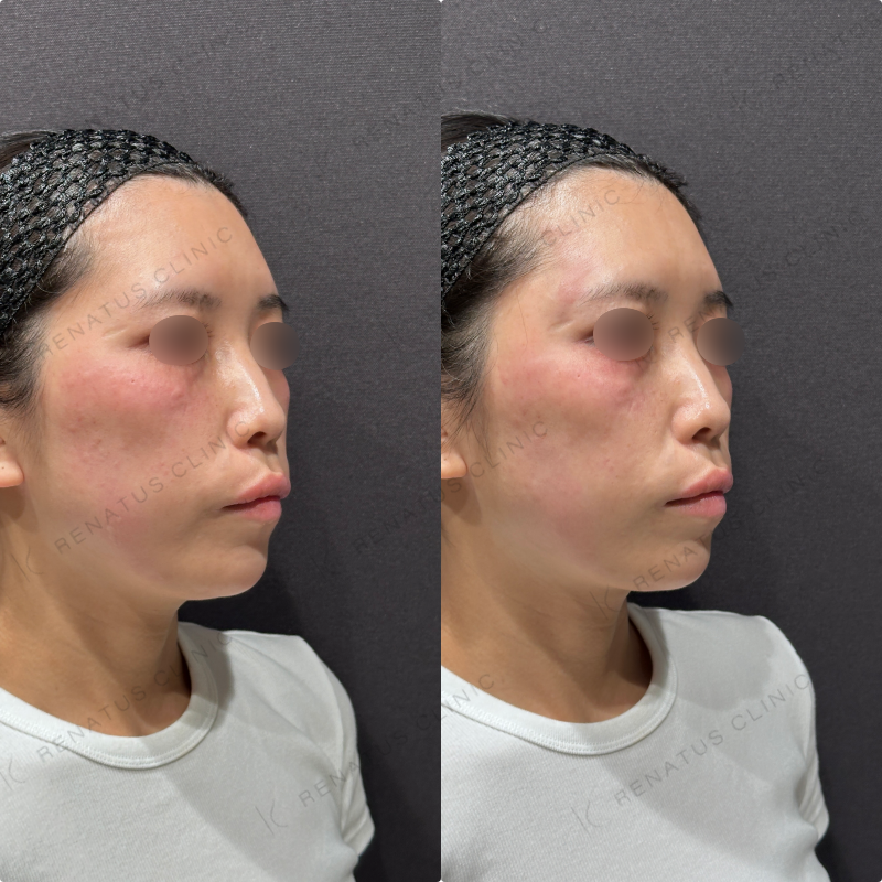 こめかみヒアルロン酸ボリューマ症例写真 こめかみヒアルロン酸ボリューマ症例写真