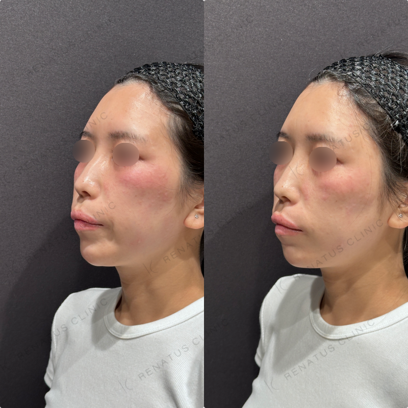 こめかみヒアルロン酸ボリューマ症例写真 こめかみヒアルロン酸ボリューマ症例写真