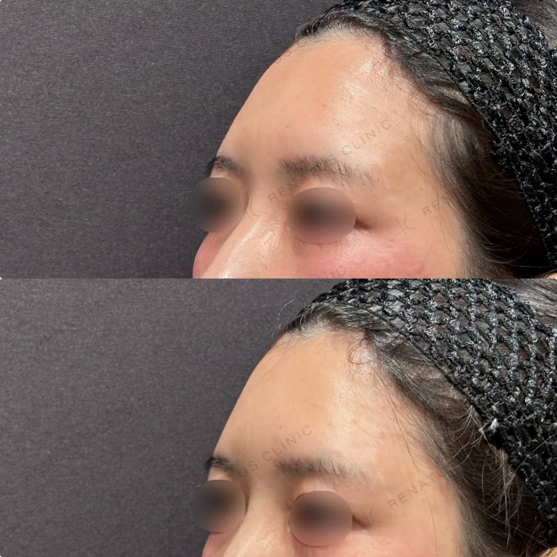こめかみヒアルロン酸ボリューマ症例写真 こめかみヒアルロン酸ボリューマ症例写真