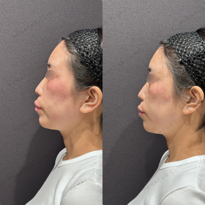 こめかみヒアルロン酸ボリューマ症例写真 こめかみヒアルロン酸ボリューマ症例写真