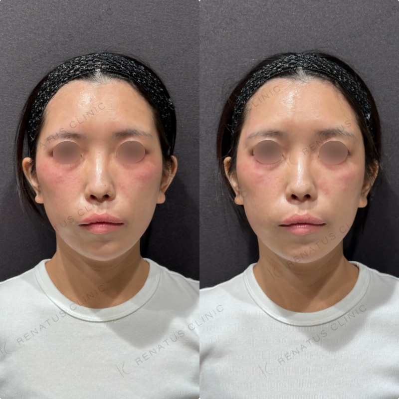 1こめかみヒアルロン酸ボリューマ症例写真 こめかみヒアルロン酸ボリューマ症例写真