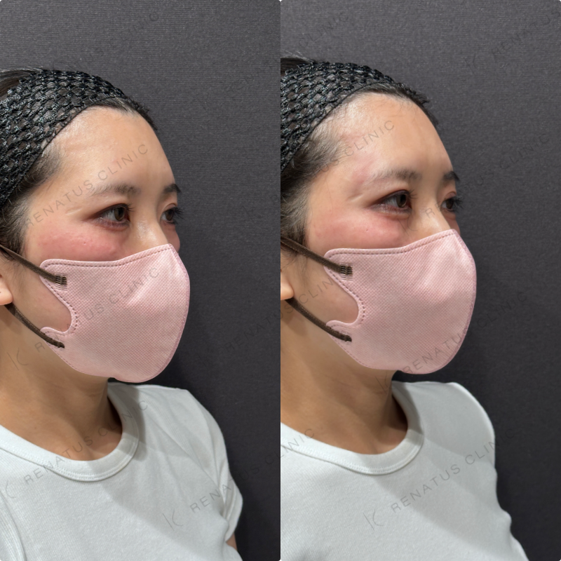 涙袋ヒアルロン酸ボルベラ症例写真 涙袋ヒアルロン酸ボルベラ症例写真