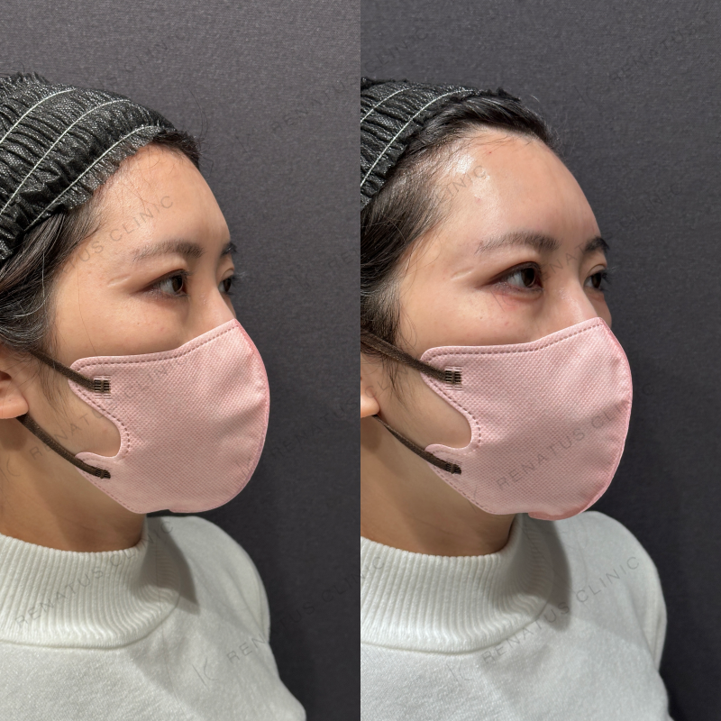 涙袋ヒアルロン酸ボルベラ症例写真
