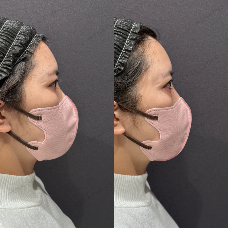涙袋ヒアルロン酸ボルベラ症例写真
