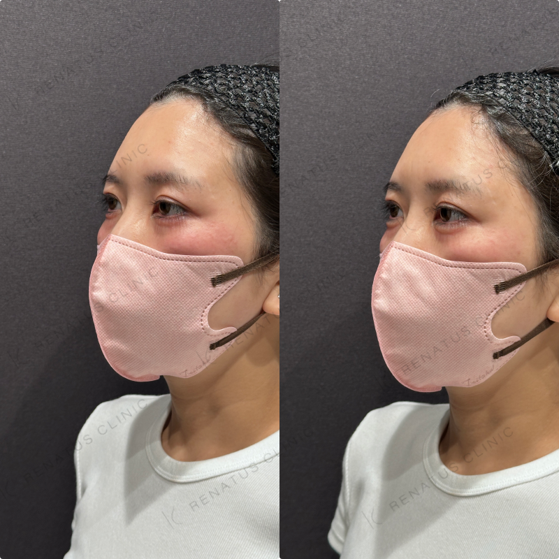 涙袋ヒアルロン酸ボルベラ症例写真 涙袋ヒアルロン酸ボルベラ症例写真
