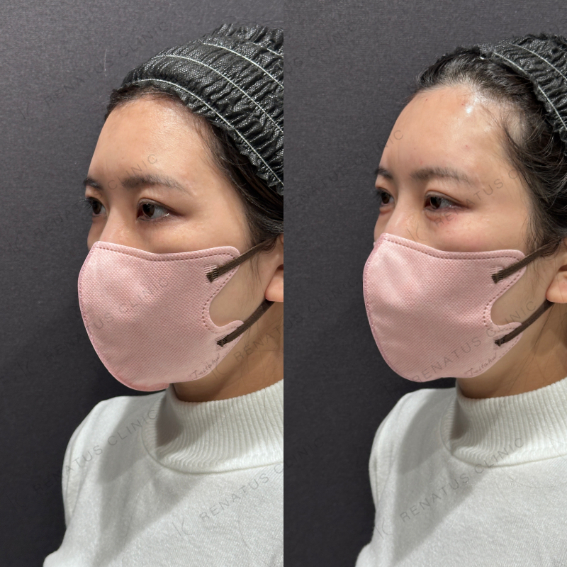 涙袋ヒアルロン酸ボルベラ症例写真