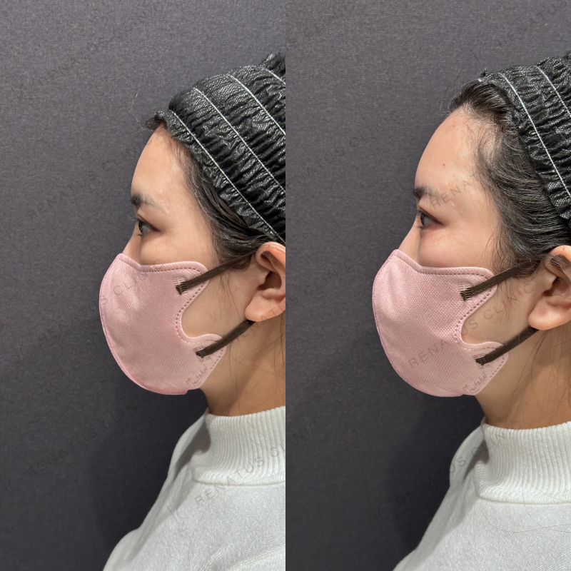 涙袋ヒアルロン酸ボルベラ症例写真