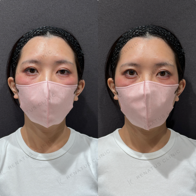 涙袋ヒアルロン酸ボルベラ症例写真 涙袋ヒアルロン酸ボルベラ症例写真