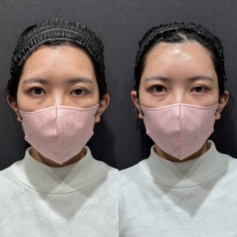 涙袋ヒアルロン酸ボルベラ症例写真