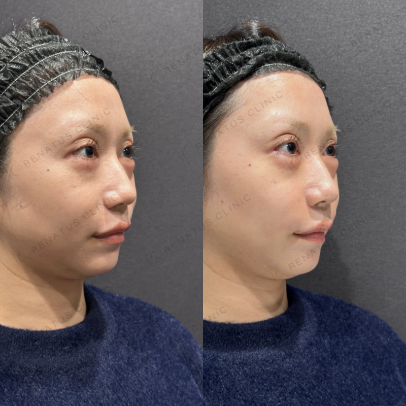 涙袋・ほうれい線ヒアルロン酸ボルベラ・ボリフト症例写真