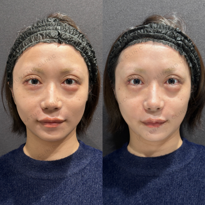 涙袋・ほうれい線ヒアルロン酸ボルベラ・ボリフト症例写真