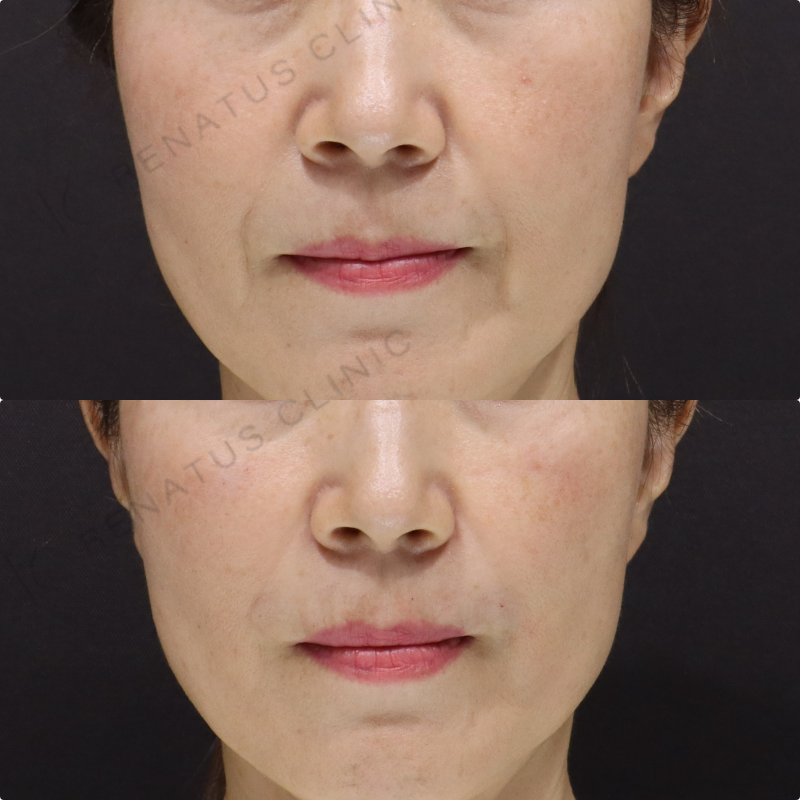鼻翼基部・ほうれい線ヒアルロン酸症例写真