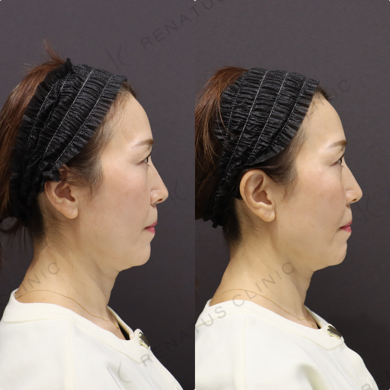 鼻翼基部・ほうれい線ヒアルロン酸症例写真