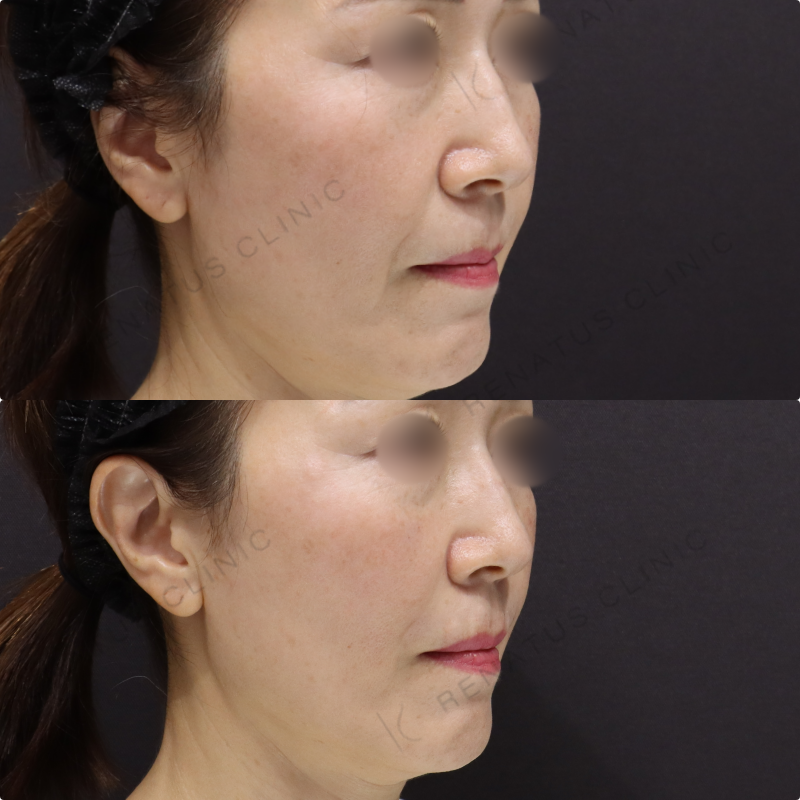 鼻翼基部・ほうれい線ヒアルロン酸症例写真