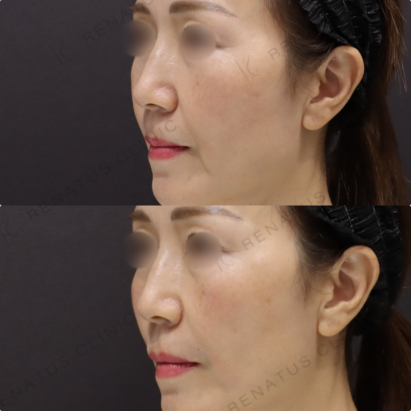 鼻翼基部・ほうれい線ヒアルロン酸症例写真