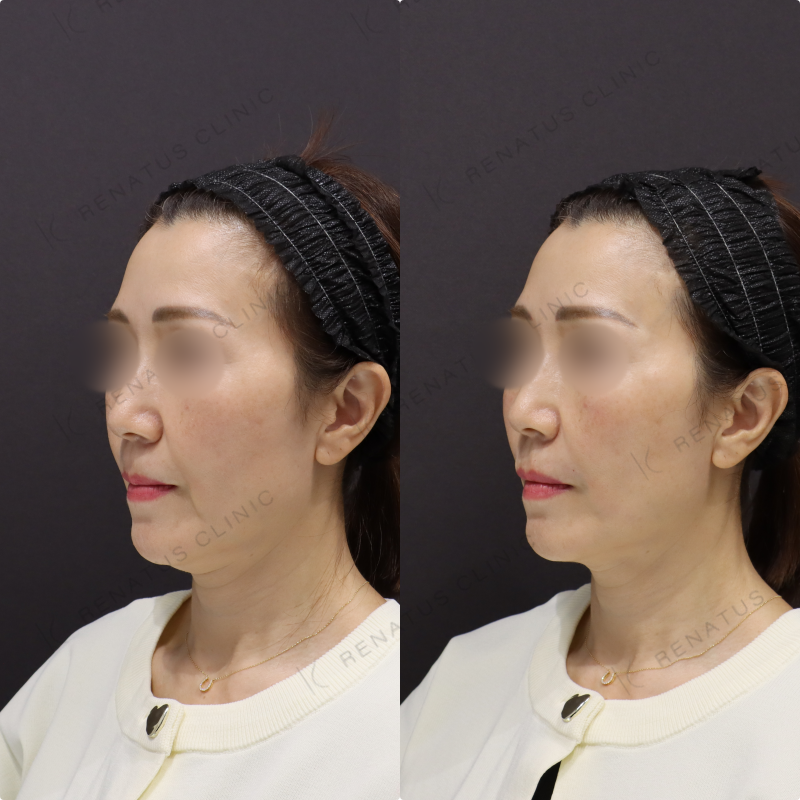 鼻翼基部・ほうれい線ヒアルロン酸症例写真